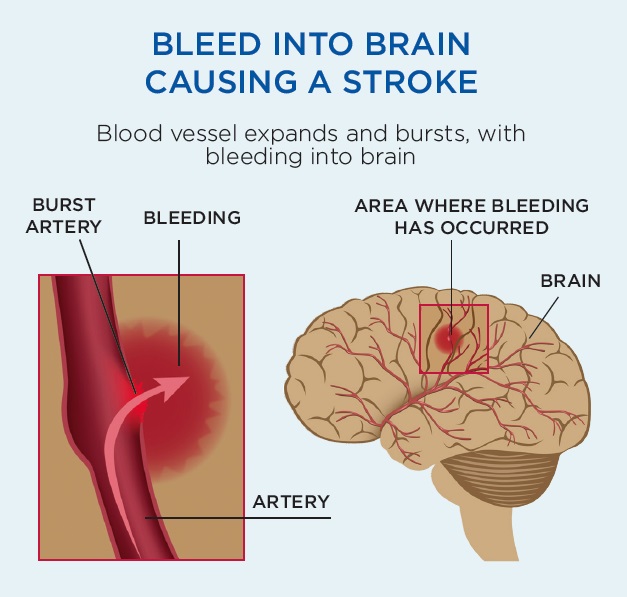 Bleed into brain causing a stroke