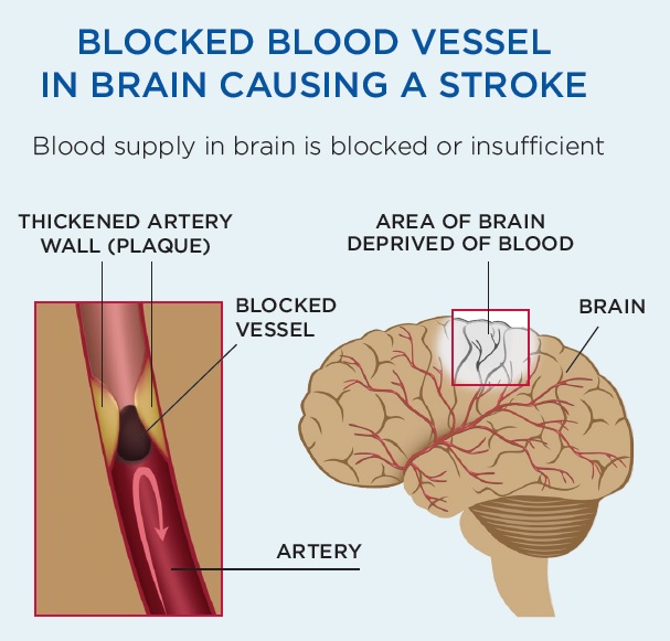 Blocked Blood Vessel in brain causing stroke